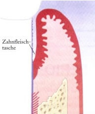Chirurgische Parodontaltherapie Braunschweig Vereinfachte Grafik zur Zahnfleischtaschenbildung